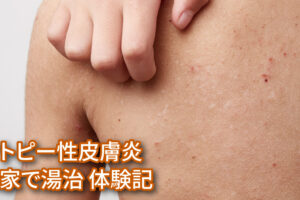 アトピーのかゆみで眠れない・寝れない夜に。<br>自宅のお風呂で取り組む「蔵王温泉・マイホーム湯治」